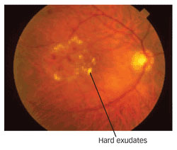 Retinal Scan Showing Hard Exudates
