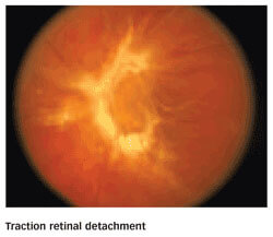 Retinal Scan Showing a Traction Retinal Detachment