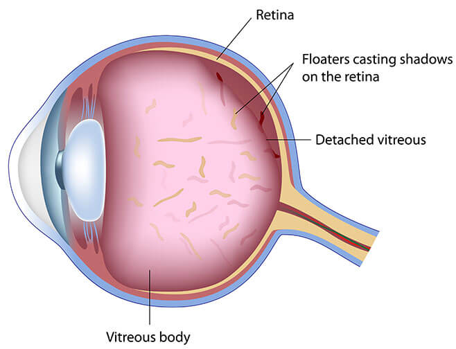 Illustrating Floaters Casting Shadows on the Retina