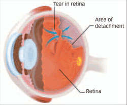 Illustrating a Tear in the Retina