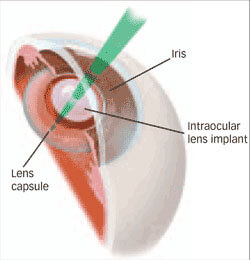 Illustrating an Intraocular Lens Implant in an Eye