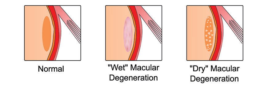 Illusrating a Normal Macular Compared to a Wet and Dry One