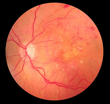 Retinal Vein Occlusion Scan