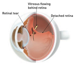 Illustrating What Causes Retinal Detachment
