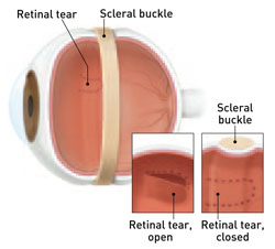 Illustrating a Scleral Buckle in an Eye
