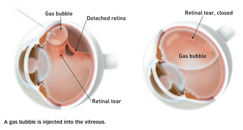 Illustrating a Gas Bubble in an Eye